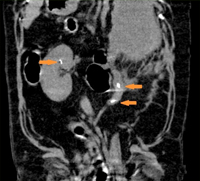 尿管結石（右矢印２つ）と腎結石（左矢印）