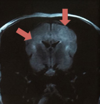 尿管結石（右矢印２つ）と腎結石（左矢印）